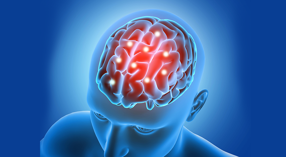 Stroke Treatment Doctors Near Me – Fast & Reliable Care