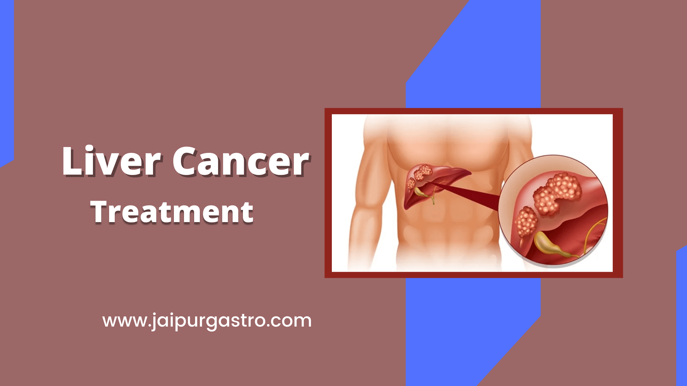 Best Liver Cancer Treatment in Jaipur | Advanced Care & Specialists